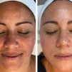 A client receiving the Sweet Skin & Laser Signature Facial, a deep-cleansing and hydrating skincare treatment designed to rejuvenate and brighten the skin.